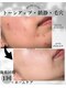 エレンシア(E'lencia)の写真/【肌質改善を目指すなら☆】結果重視!1回でも変化を実感◎ハーブピーリングで毛穴レスの理想のツヤ肌へ。