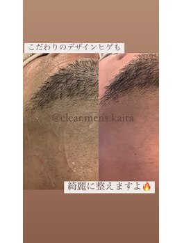 クリアー(clear)/髭脱毛　お任せください