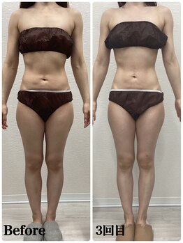 ルピア(L'pur)/痩身のビフォーアフター★