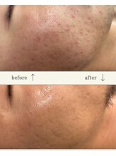 リメレ(Rimere)/ニキビケア