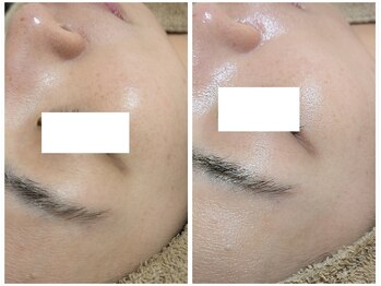 アン(anne)/優しいハーバルメソッド×8回