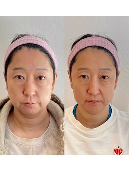 小顔22 ボルティ 赤坂支店(Bolty)/【悩み】40代：たるみ