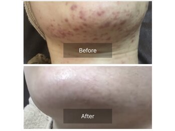 モカ 天王寺店(MOKA)/顎ニキビ　ハーブピーリング