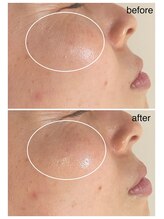 グリンプラス(grin+)/シワ改善/桂駅/フェイシャル