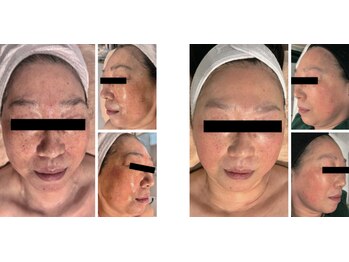 Nビューティー/セルフシミケアプログラム