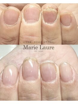 マリーロール 天王寺店(Marie Laure)/自爪育成/深爪矯正/ネイルケア