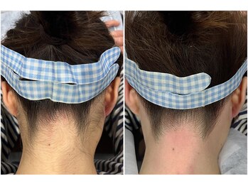 サロン ラズリ 久留米店(SALON Lazuli)/【うなじ脱毛】高さ合わせも◎