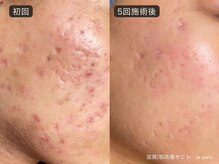 ジュパール(je pars)/TIPハーブピーリング剥離あり