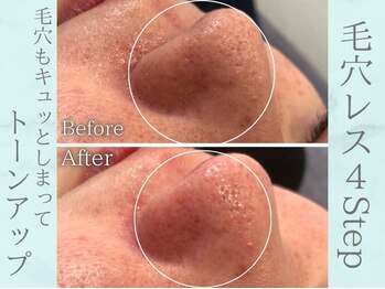 ネオファースト(NeoFirst)/毛穴レスで皮脂詰まりにゼロへ♪