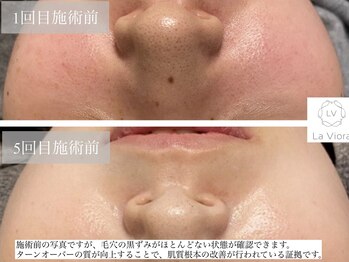 ラヴィオーラ 神戸三宮店(La Viora)/ダイヤモンドハーブピーリング