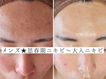 ユウビジン(YOU美人)/MEN'Sニキビ改善