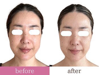 ティアラ/before after　小顔