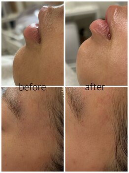 ピース(PEACE)/フェイシャルツヤ肌ワックス