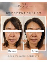 エクラヴィ(Eclatvie)/４０代★施術事例