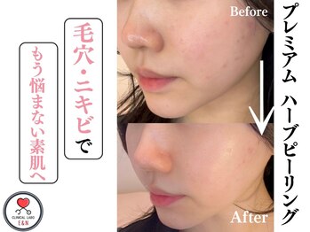 エン クリニカルラボ 心斎橋店(E&N CLINICAL LABO)の写真/【本気の肌管理】韓国ピーリングハイドラ毛穴洗浄で毛穴詰まり、引き締め、くすみケア♪敏感肌の方にも☆