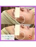 【毛穴/シミ/ニキビケア/乾燥の悩みに】ハーブピーリング+光フォト