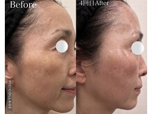 ウォーム(Warm)/60代　マイクロニードル施術例