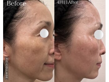 ウォーム(Warm)/60代　マイクロニードル施術例