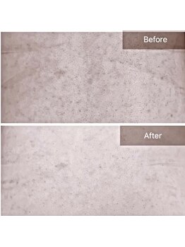 ビビ(VIVI)/ハーブピーリング背中ケア