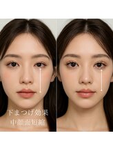 ジョリー(JOLi)/中顔面短縮