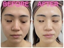 ホッコリ 府中店(HOKKORI)/BBL光フェイシャル～シミケア◎