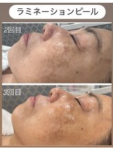 シャンディ(Shandy)/ラミピール☆ビフォーアフター