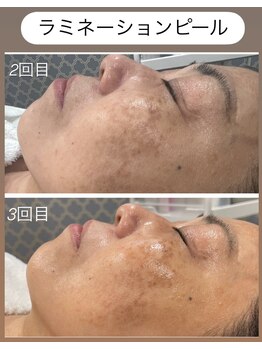 シャンディ(Shandy)/ラミピール☆ビフォーアフター