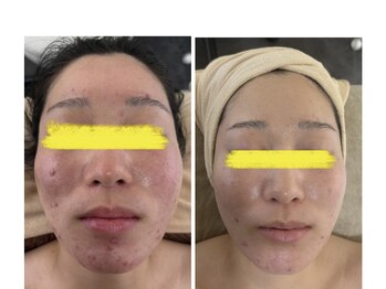 マーレン(Malen)/ニキビ集中ケア