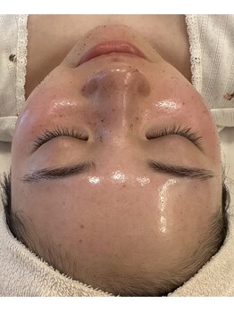 エイティ(Atey)/ハーブピーリング自然発光肌へ☆