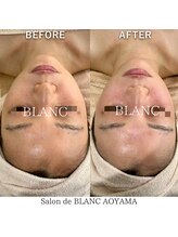 サロン ド ブラン アオヤマ(Salon de BLANC AOYAMA)/ハーブピーリング×ソノケア90分