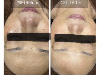 ケイ(Kei)/肌質改善コースbefore/after　　