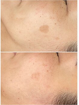 ミヨン(Miyong)/最新技術☆魔法のスティック