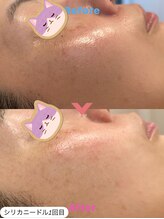 はだなの/ビフォーアフター　シリカ微細針