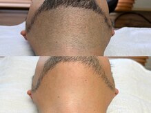 フェリス(FELIZ)/メンズ脱毛人気No.１