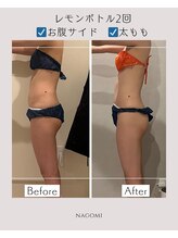 なごみ 菊池店/脂肪撃退【レモンボトル2cc】