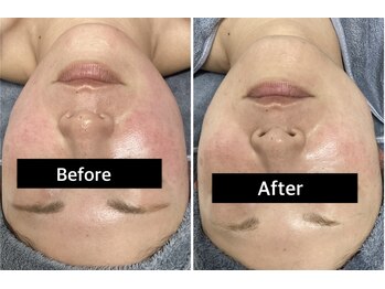 ミー(ME.)/40代女性(赤ら顔)