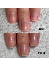 ルアナ(LUANA)/自爪育成お客様ビフォーアフター