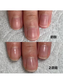 ルアナ(LUANA)/自爪育成お客様ビフォーアフター