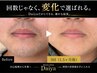 【青ヒゲ卒業】朝剃っても夕方青い人へ|3回で薄く実感 ¥12,500→初回¥9,900