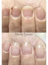 マリーロール 天王寺店(Marie Laure)/自爪育成/深爪矯正/ネイルケア