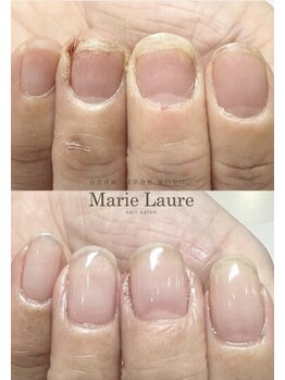 マリーロール 天王寺店(Marie Laure)/自爪育成/深爪矯正/ネイルケア