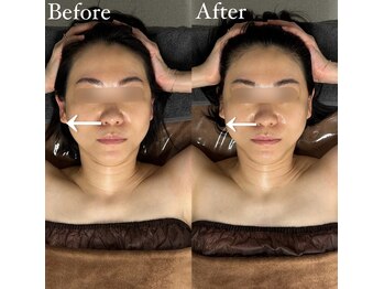 ブレスト サロン 奈良店(Bryst Salon)/小顔症例