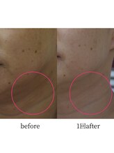 アップルミント/＜フェイシャル＞before・after