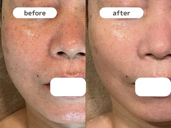 サンゴ(Sango)/毛穴/シミ/たるみ改善