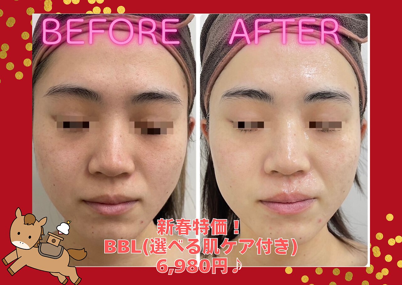 広島県で光フェイシャルが人気のエステサロン｜ホットペッパービューティー