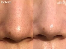 ホワイトアクア 梅田本店(WHITE AQUA)/ハーブピーリング/毛穴洗浄/梅田