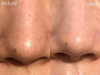 ホワイトアクア 梅田本店(WHITE AQUA)/ハーブピーリング/毛穴洗浄/梅田