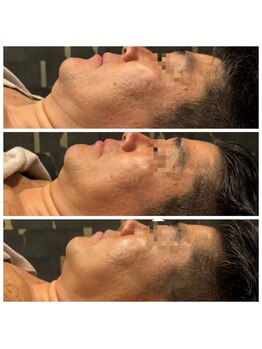 ビュウナ 銀座(BEAUNA)/カルテットモード全顔