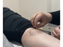 アレス鍼灸整体サロン/打撲のお灸