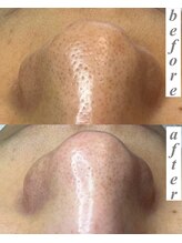 ライカブルー(RaicA BluE)/施術写真　before-after